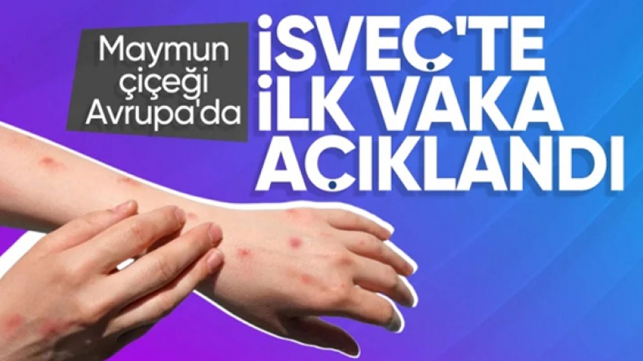 Maymun çiçeği virüsü İsveç'te görüldü