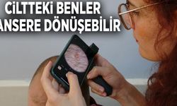 Ciltteki benler kansere dönüşebilir