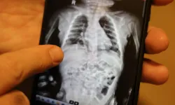 200 Binde Bir Görülen Nadir Hastalık Başarıyla Tedavi Edildi