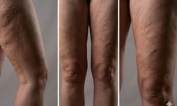 Lipödem Nedir? Uzman İsim Ağrılar için uyardı