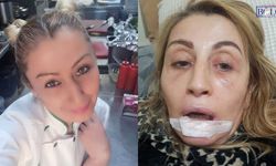 Estetik Hayali Kabusla Bitti! Dudakları Çürüdü