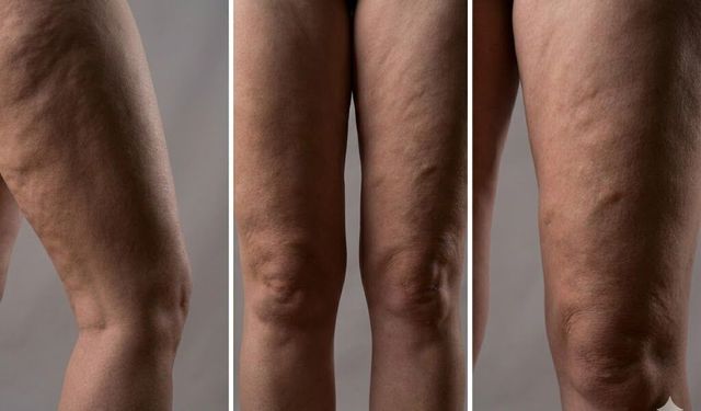 Lipödem Nedir? Uzman İsim Ağrılar için uyardı