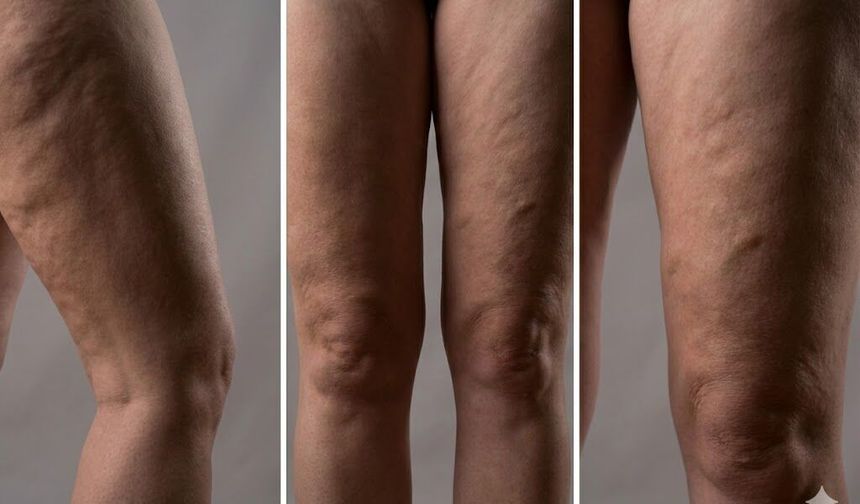 Lipödem Nedir? Uzman İsim Ağrılar için uyardı